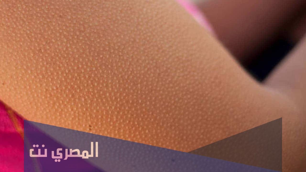 معلومات عن علاج جلد الوزة