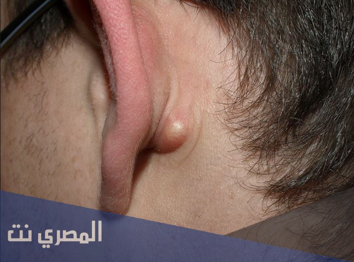 ورم خلف الأذن أسبابه وعلاجه