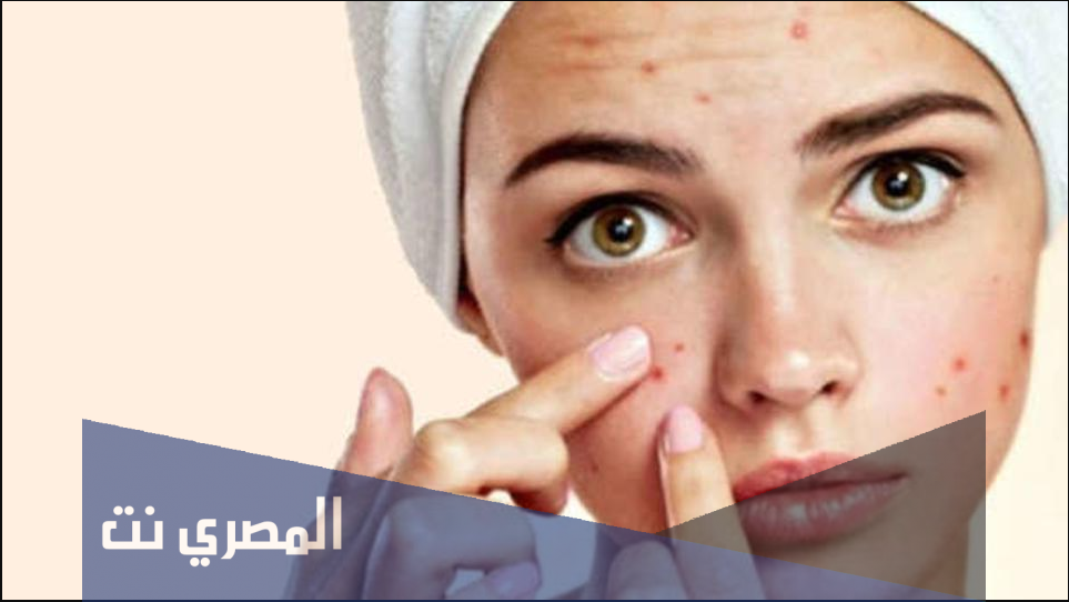 كريم باليزاج Palizage لعلاج حب الشباب