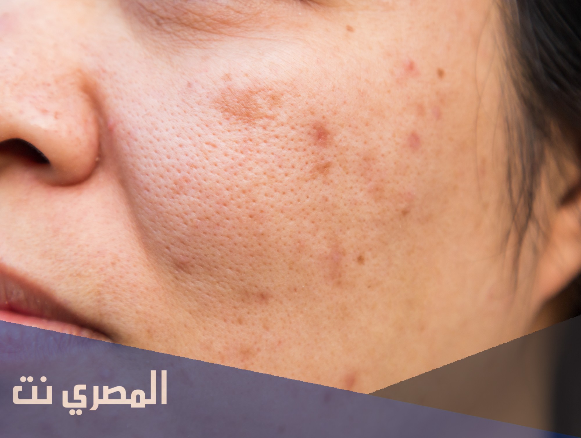 تجربتي مع تصبغات الوجه
