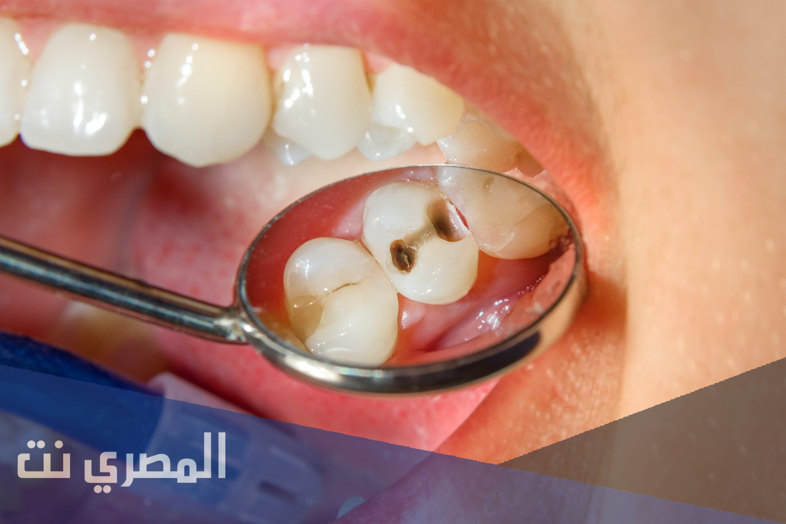 ما السبب المحتمل لتسوس الأسنان