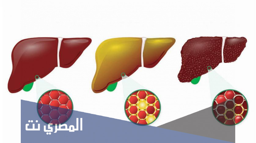 تجربتي في إزالة دهون الكبد