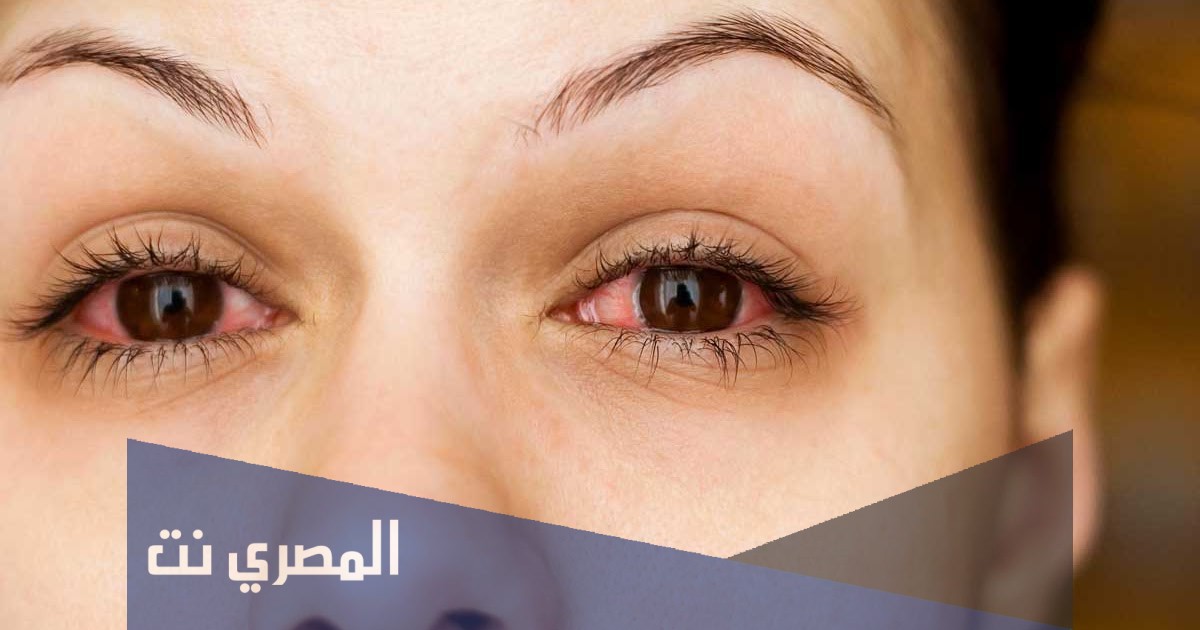 قطرة عين بيلوكاربين Pilocarpine لعلاج ارتفاع ضغط العين