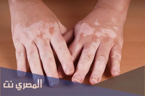 كبسولات بسورين Psorin لعلاج البهاق