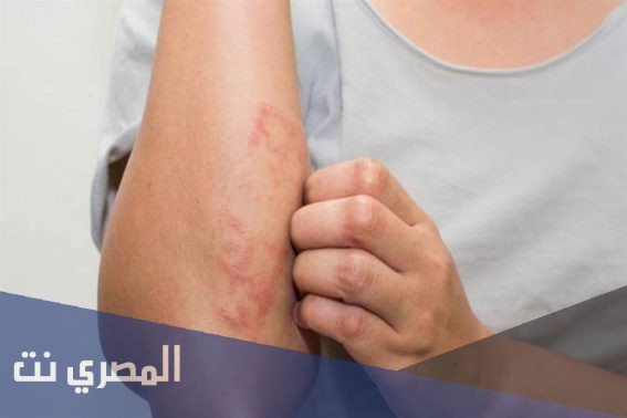 كريم بروباكتسين Probactcin لعلاج قرح الجلد والجروح