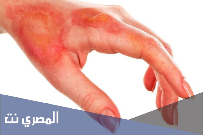 كريم بينتابورن Pentaburn لعلاج الحروق والجروح