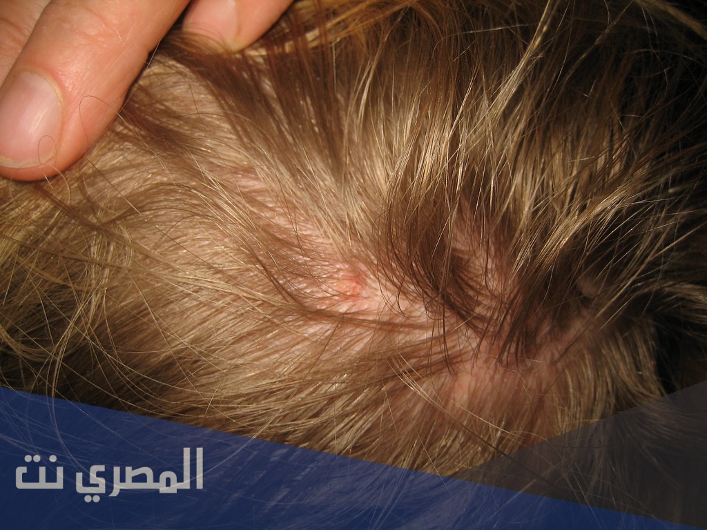كيف يظهر القمل والصيبان في الشعر