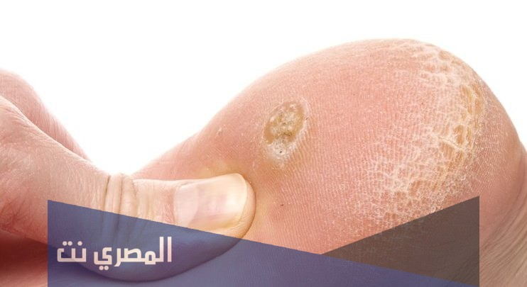 ما هي ادوية علاج مسمار القدم