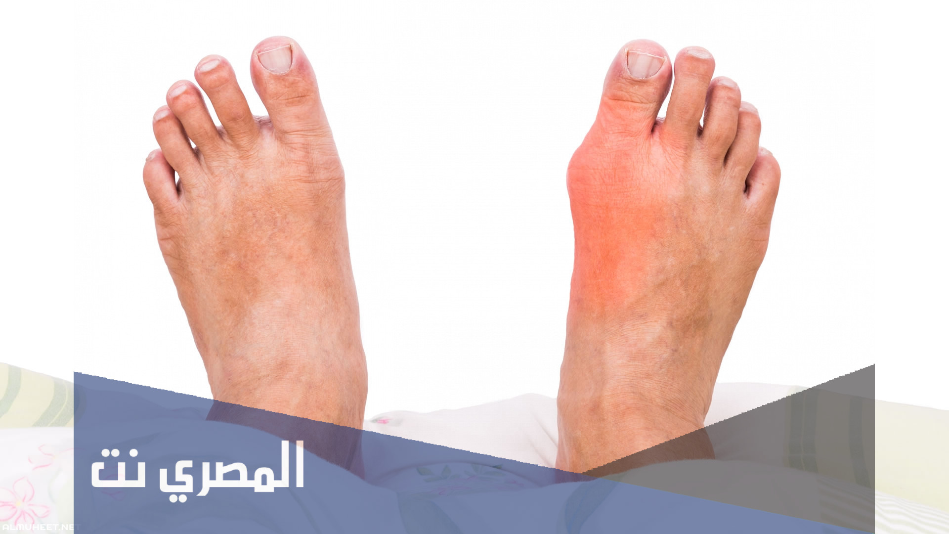 ماذا يدعى مرض النقرس