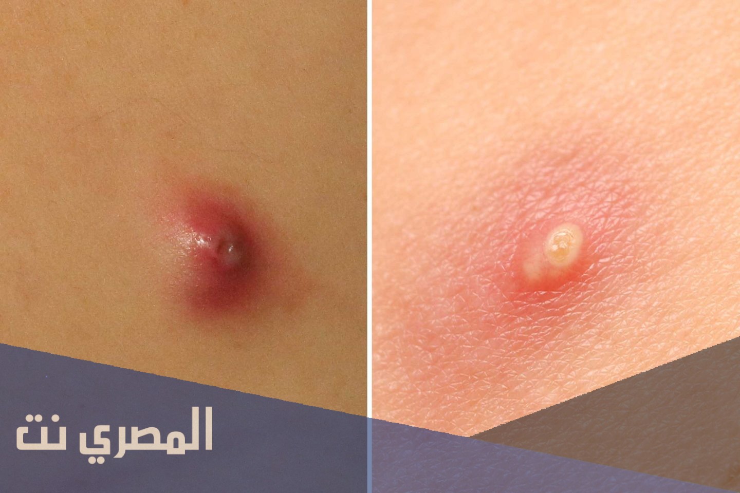 مرهم باكتروسين Bactrocin لعلاج الدمامل والتهابات الجلد