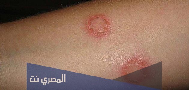 كريم بيوتاكسيمارك Butaximark لعلاج الفطريات الجلدية