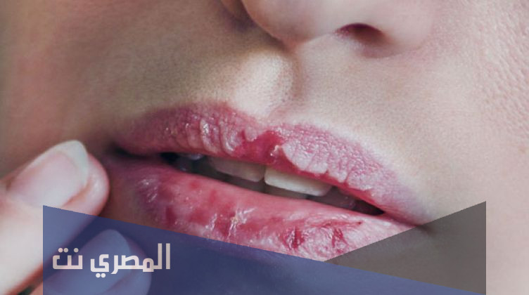 الخلطات الطبيعية لعلاج تشقق الشفاه بمكونات منزلية