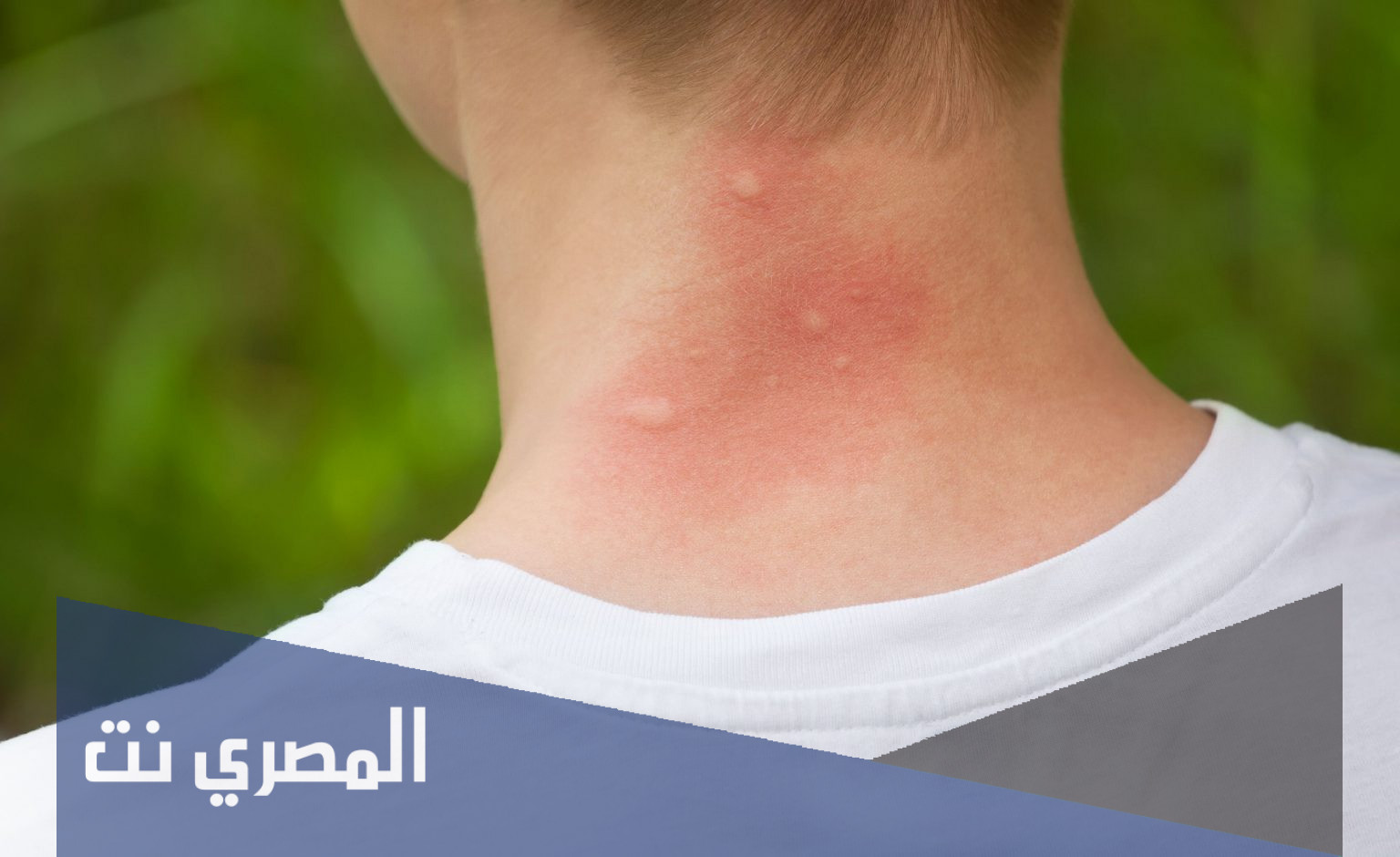 دواعي إستخدام كريم ديرمافلوتيزون Dermaflutisone لعلاج حساسية الجلد 2022