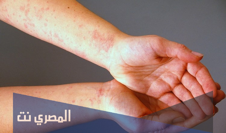 كريم ديفوزين Divozine لعلاج الالتهابات الجلدية والجرعة المناسبة