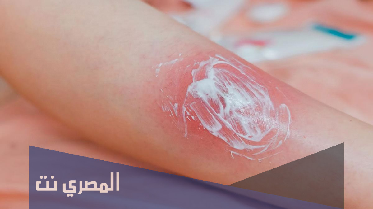 استخدم كريم ديرمال Dermal Cream لعلاج الالتهابات الجلدية 2022