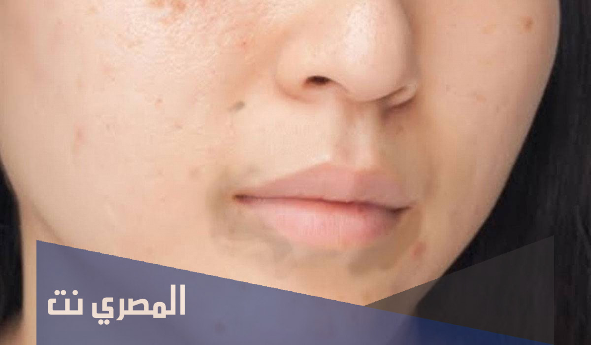 وصفات طبيعية لتفتيح منطقة حول الفم جديدة 2022