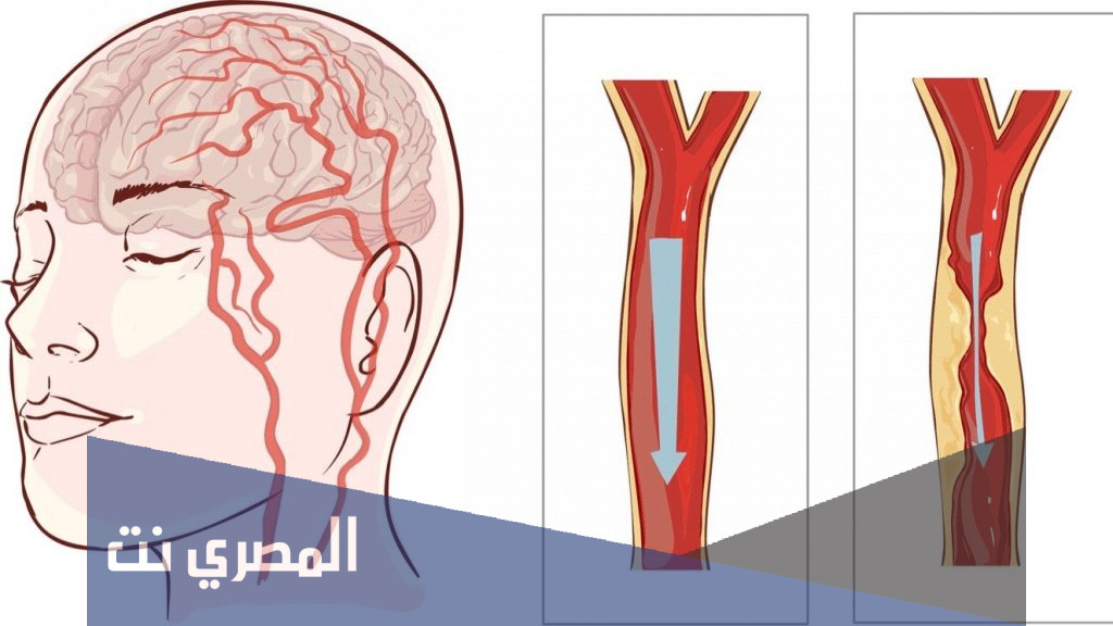 دواء سيريبال cersbal حبوب لقصور الدورة الدموية