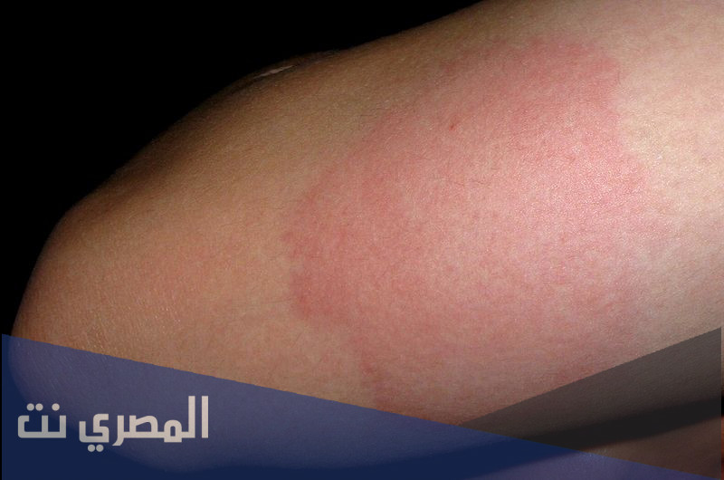 دواء سبورانوكس Sporanox كبسولات للعلاج الوقاية من الفطريات الجلدية