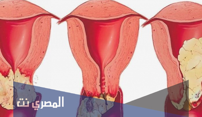 دواء روزا Krema Rosa كريم مضادة للفطريات المهبلية وآثاره الجانبية