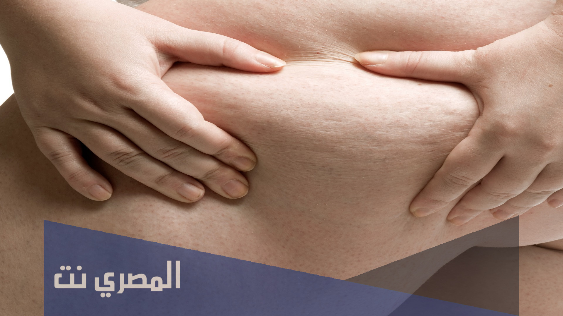 ما هو السيلوليت اسبابه وعلاجه