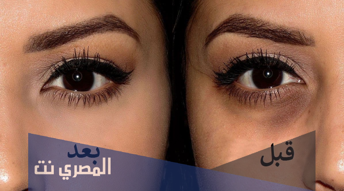 تجربتي في علاج تورم العين بسبب ضربة