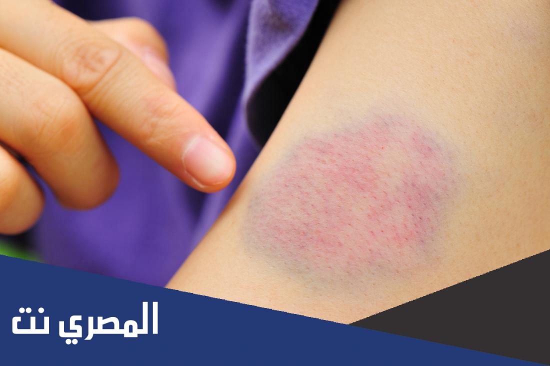طريقة التخلص من كدمات الوجه