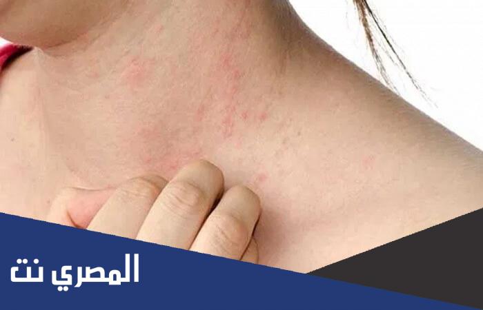 علاجات طبيعية لفطريات الجلد