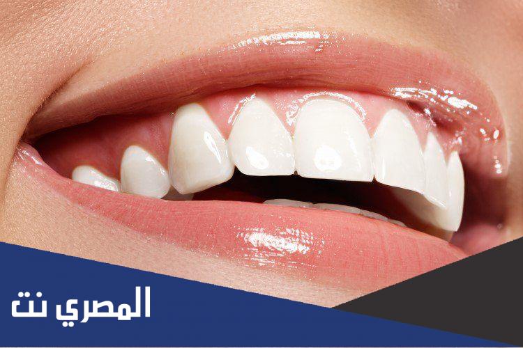 كم سعر ابتسامة هوليود في السعوديه