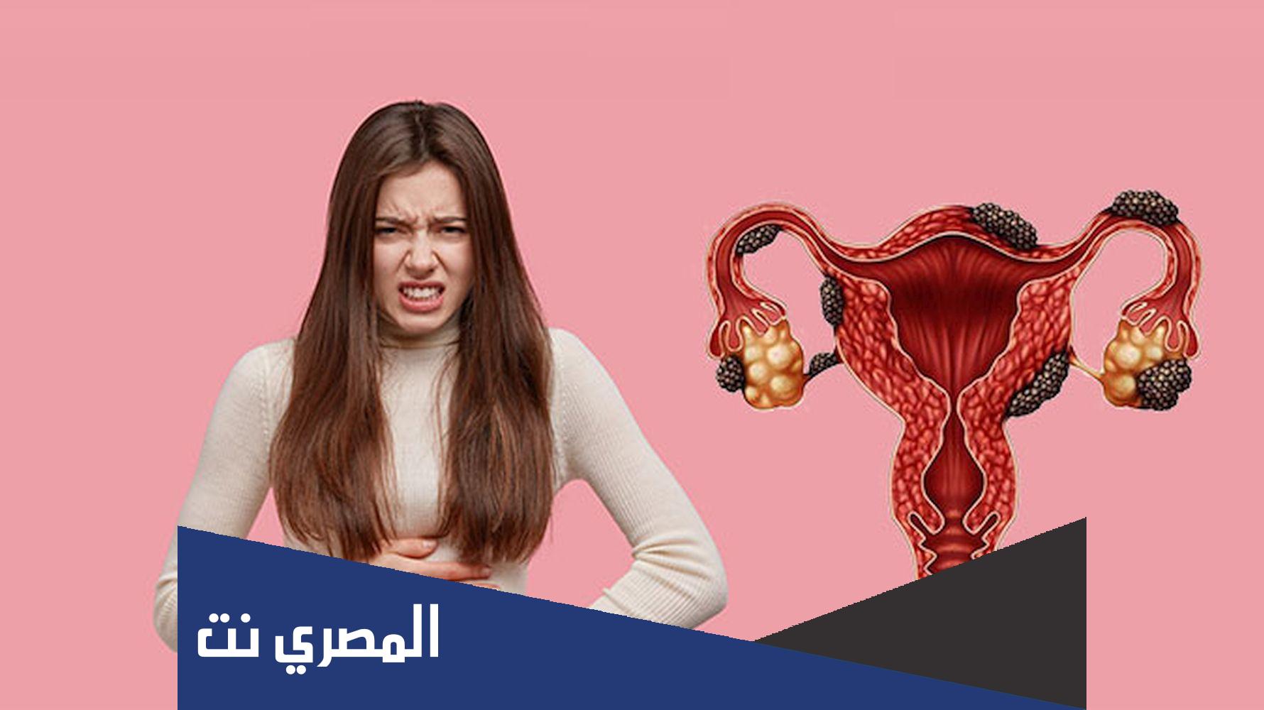 ماذا يعني مصطلح أكياس الشوكولاتة على المبيض