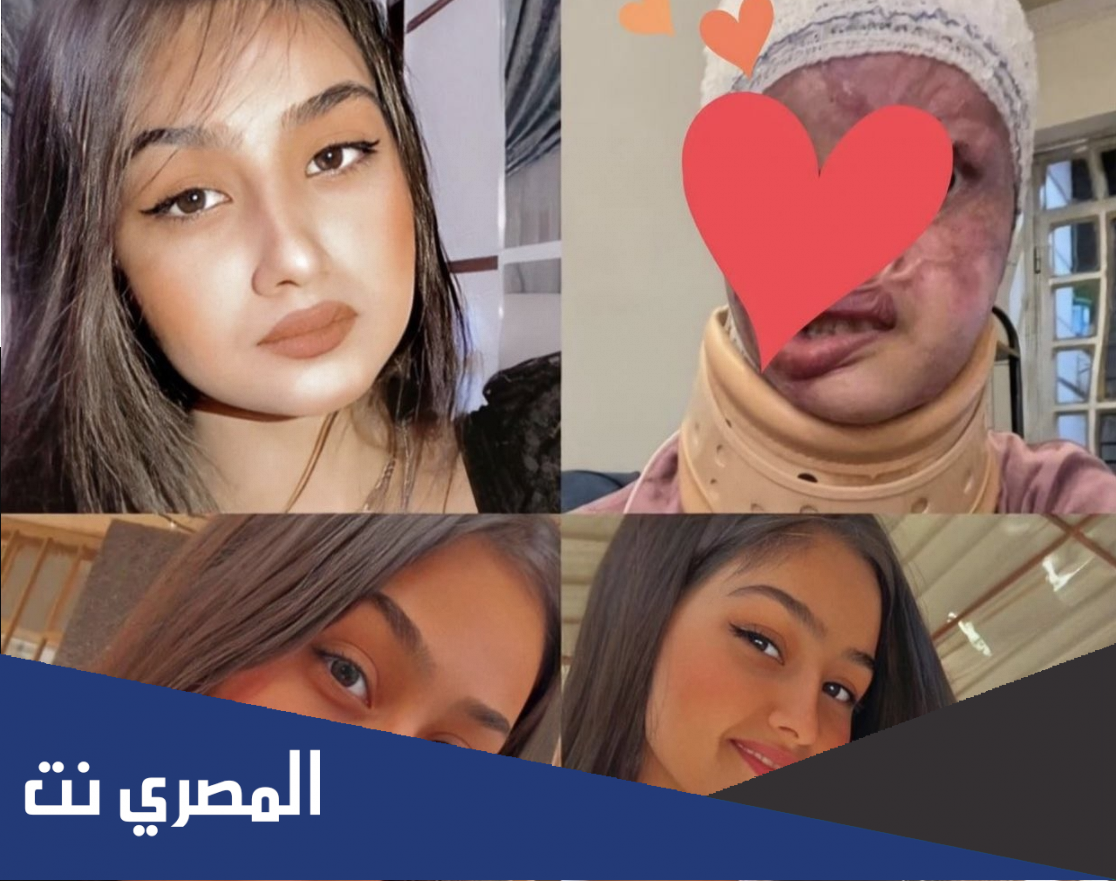 ماهي ماده التيزاب التي حرقت وجه الاميرة مريم