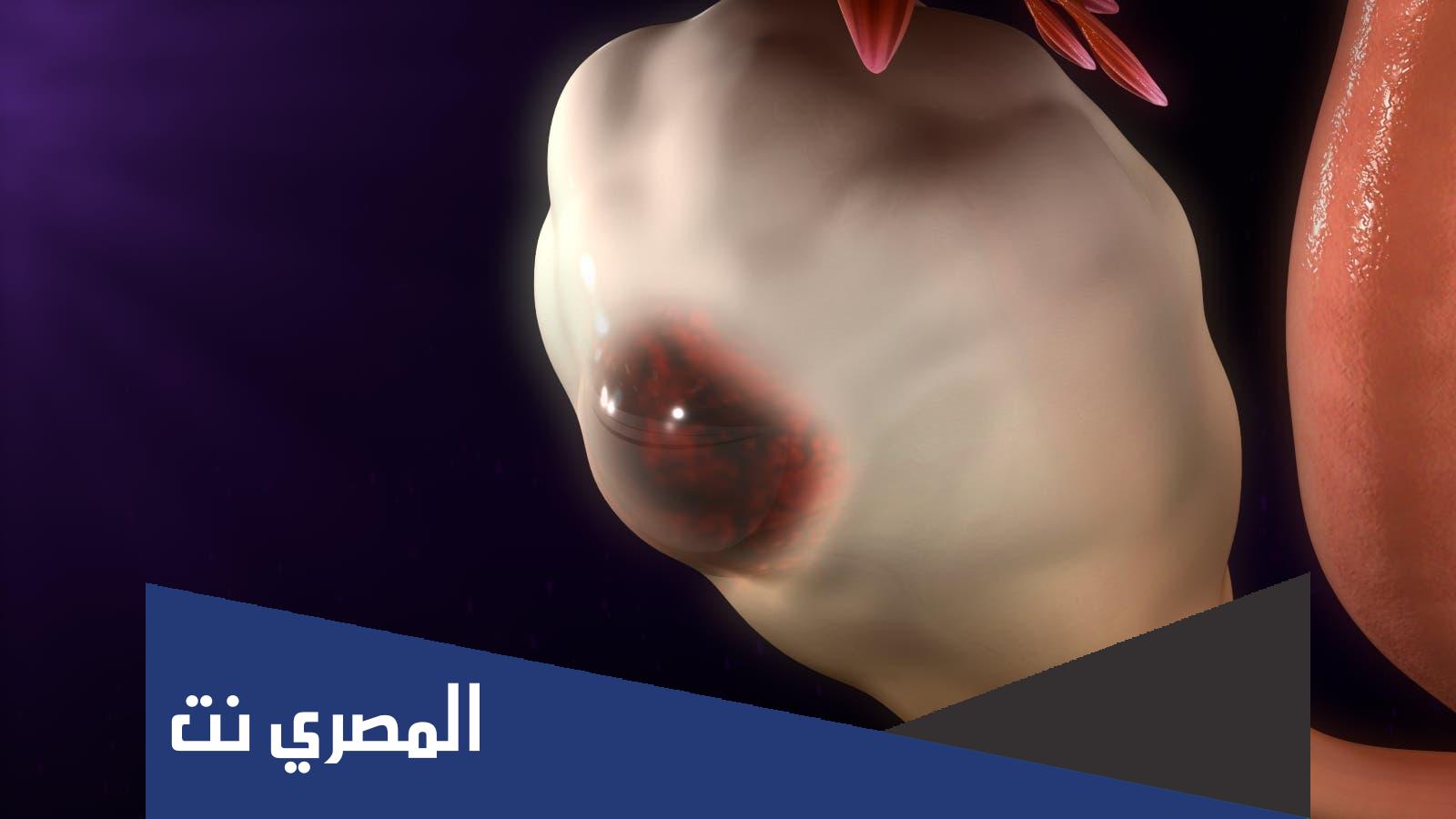 هل اكياس الشوكولاته لها علاج
