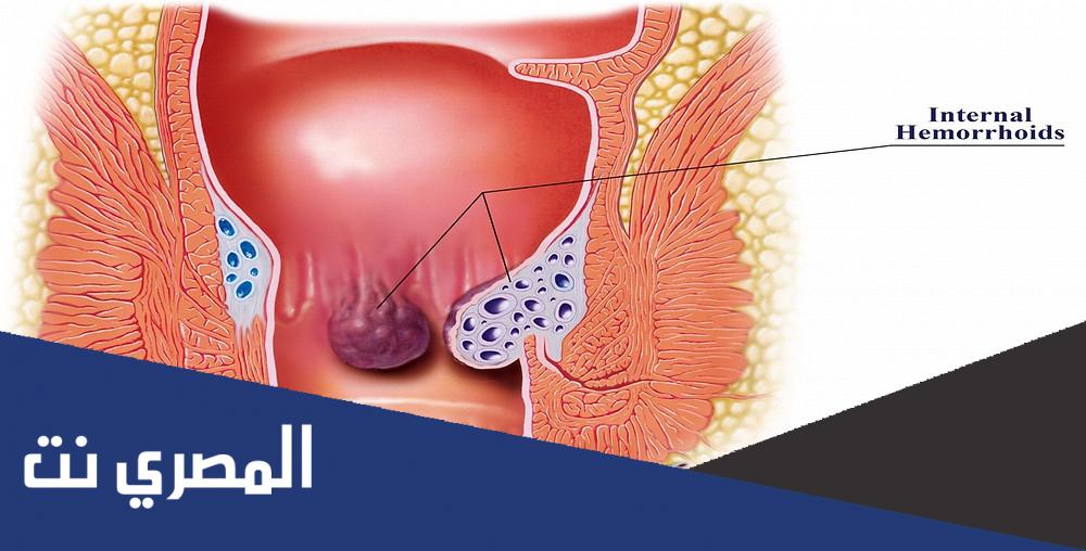 كيفية التخلص من البواسير في دقيقتين