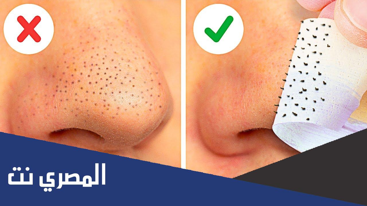 ازالة الرؤوس السوداء من الانف