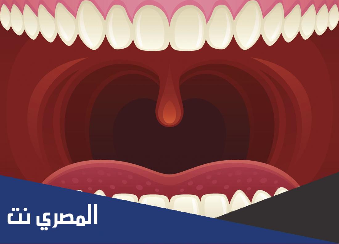 التهاب سقف الحلق وعلاجه