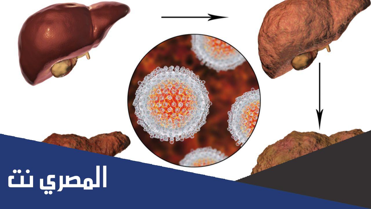 المراحل الأخيرة لسرطان الكبد