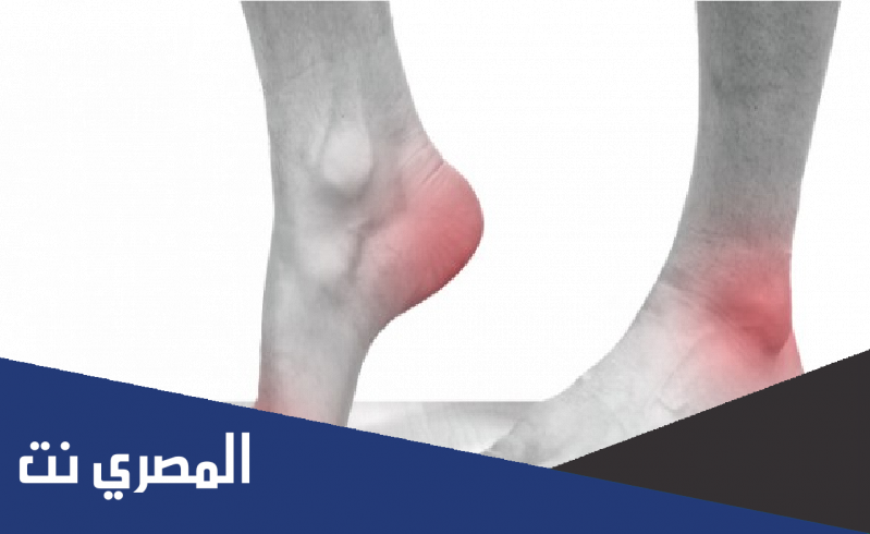 ما هو مرض النقرس