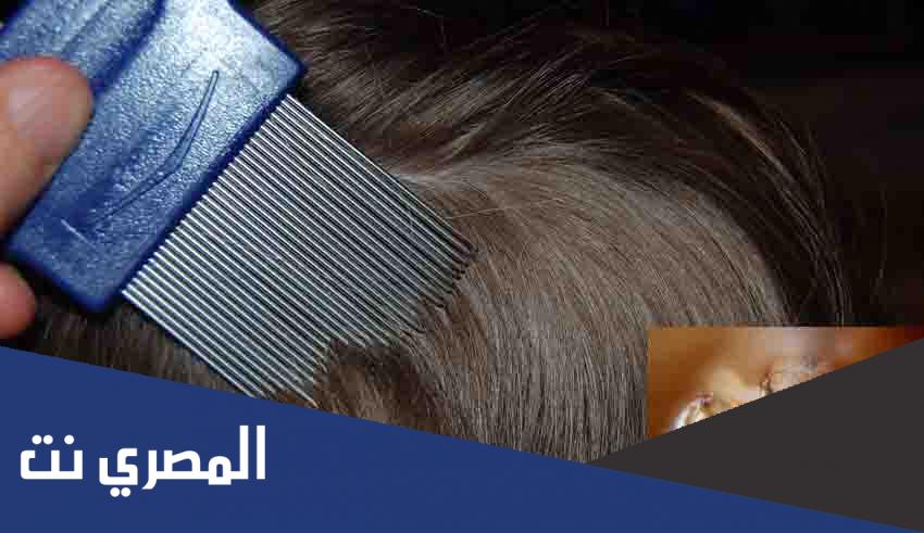 افضل علاج للقمل والصيبان من الصيدلية