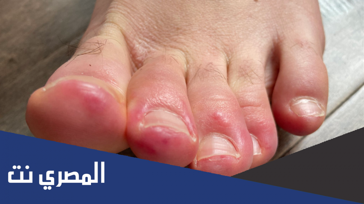 ما هو سبب تورم اصابع القدمين في الشتاء