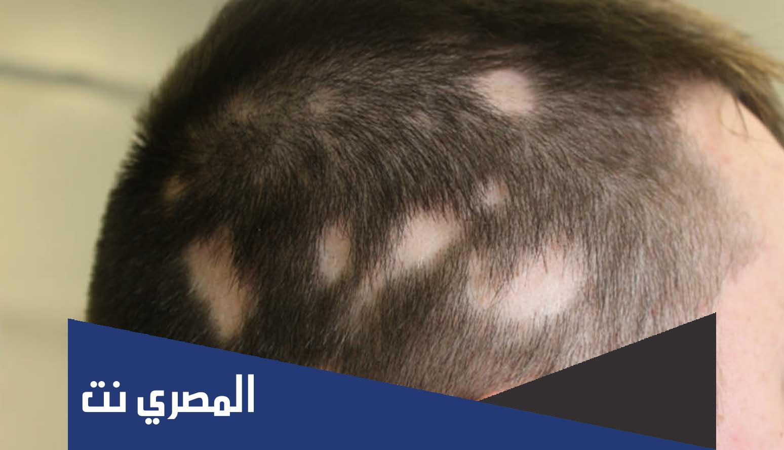 مرض الثعلبة واسبابه