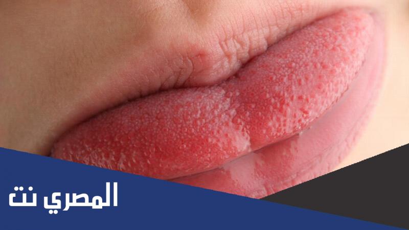 معلومات صحية عن علاج التهاب اللسان وعلاجه