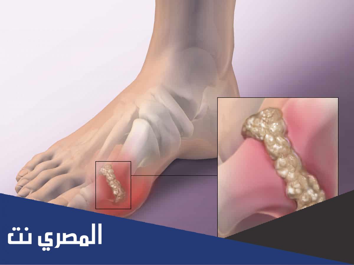 جيل برودكسن Prodexin لعلاج التهاب المفاصل الروماتيدي ونتائجه