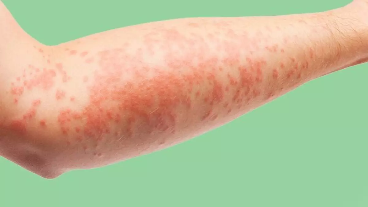 أعراض حساسية الدم وعلاجها