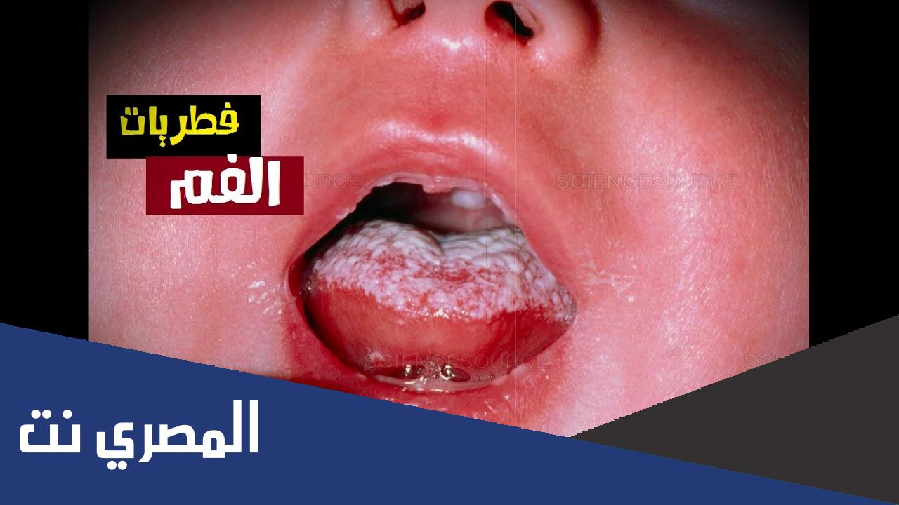 احدث طرق علاج فطريات الفم