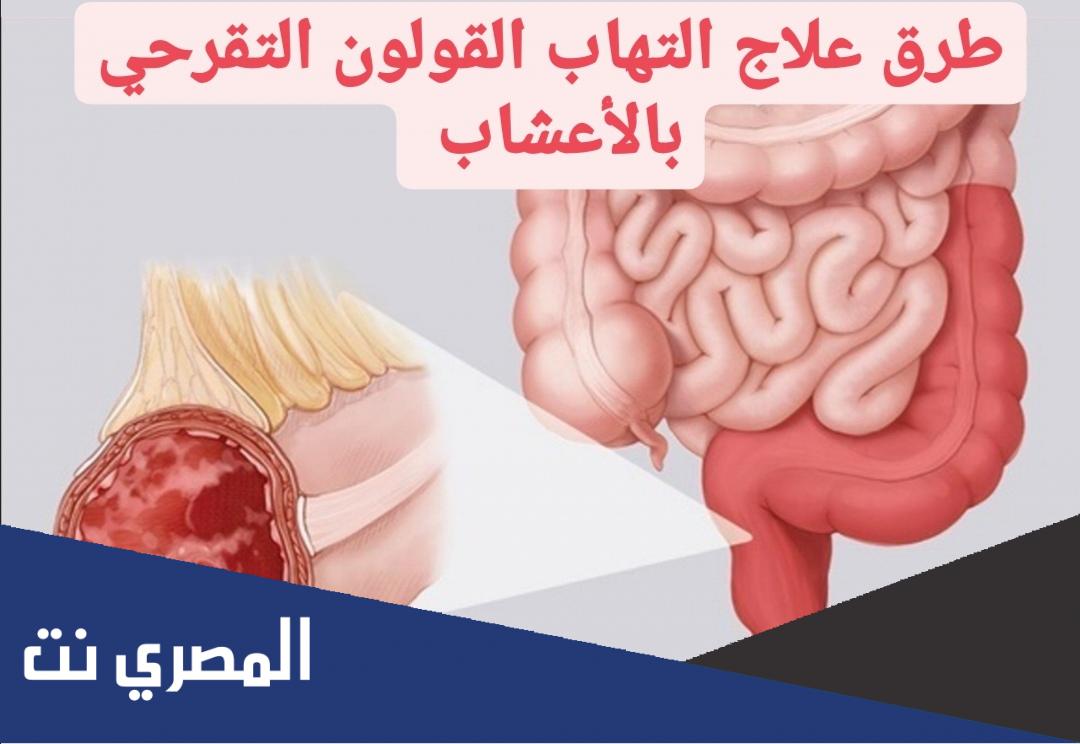 احدث علاج لمرض التهاب القولون التقرحي