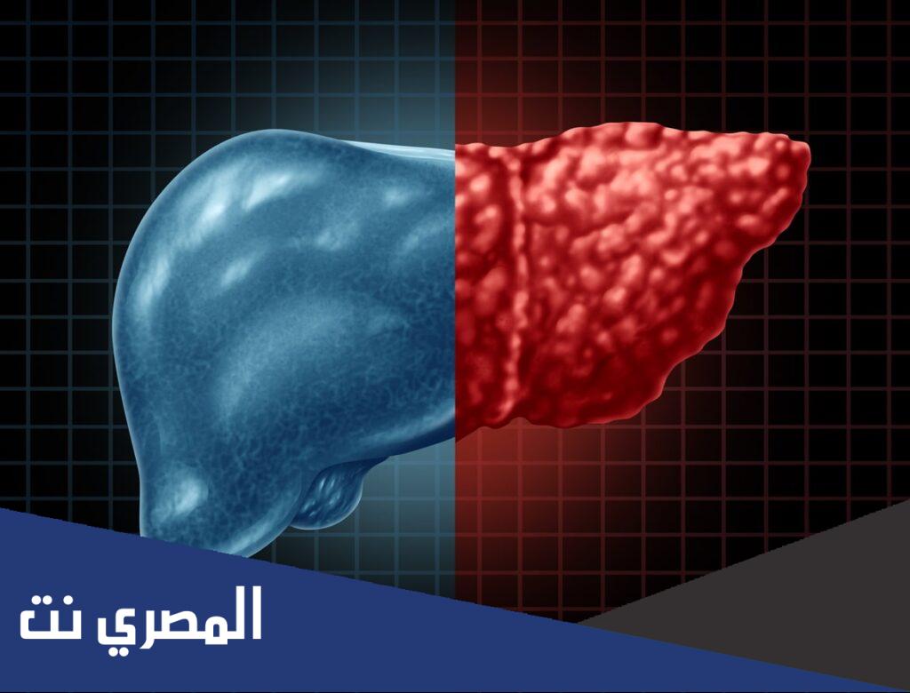 المرحلة الرابعة من تليف الكبد