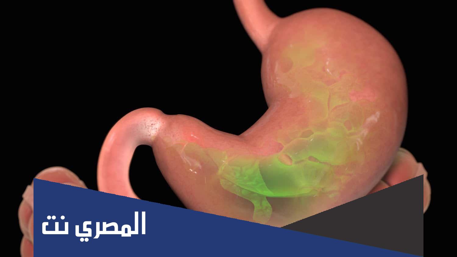 كم تكلفة عملية التكميم في جدة 2022