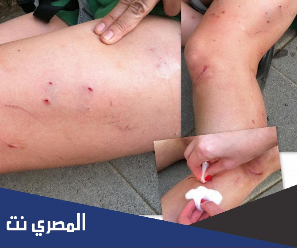 خربشة القطة وعلاجها
