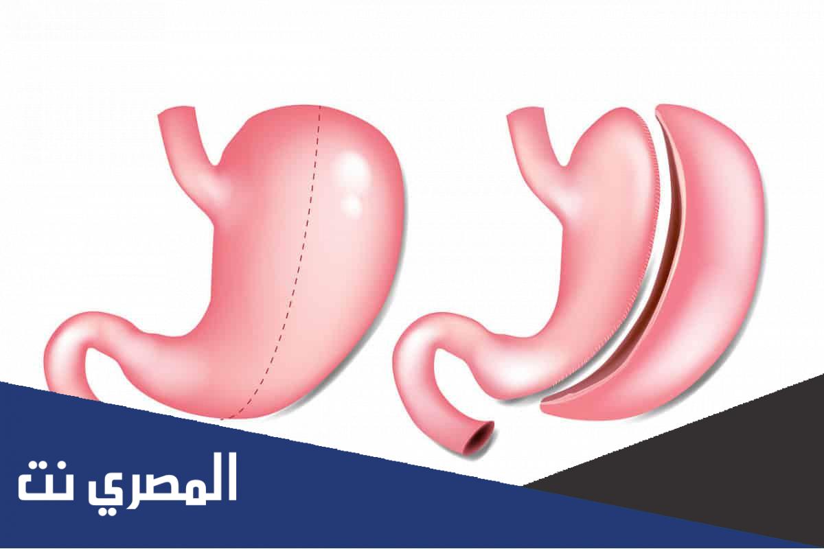 كم تكلفة عملية تكميم المعدة في الدمام