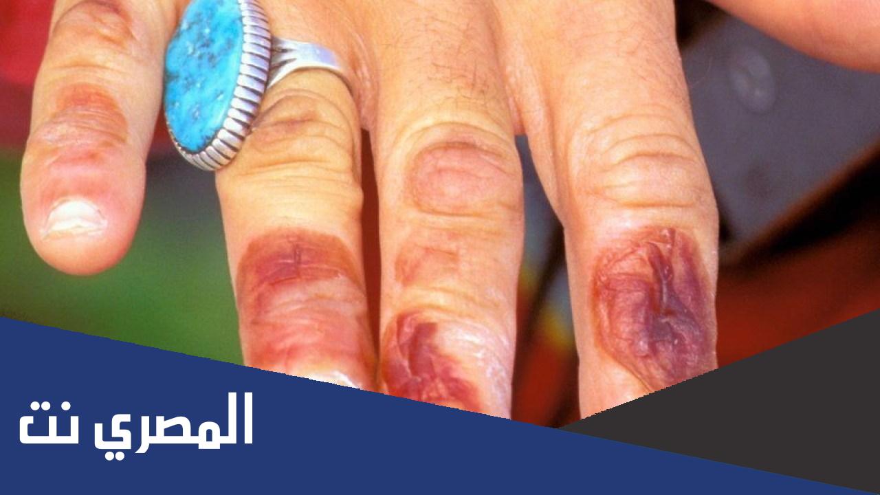 ما معنى كلمة عضة الصقيع