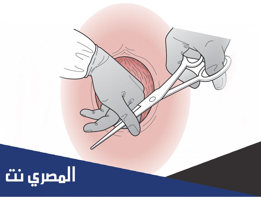 ما هو شق العجان